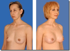 breast_enlarge