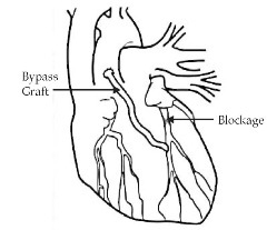Before bypass surgery (left) the blockage in the artery threatens to cut off blood flow; after surgery to graft a piece of vein (right), the blood can flow around the blockage.