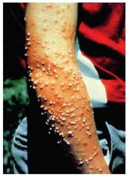 A child's arm showing many pustules after numerous fire ant stings. 