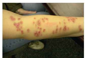 Lesions where Ekbom sufferer has attempted to extract putative "bugs" from the skin.