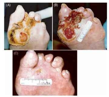 The left foot of a 73-year-old man who was treated for 3 years by orthopedic and podiatric surgery for his chronic foot ulcers: (A) before, (B) during, and (C) 1 year after maggot debridement therapy.