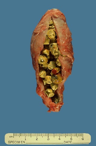 [gallstones[3].jpg]