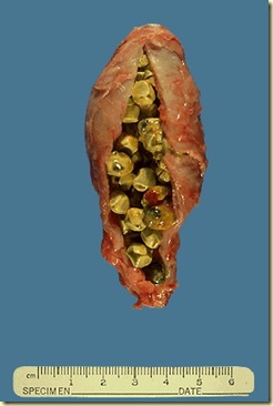 gallstones