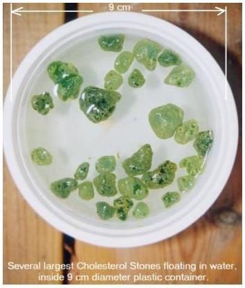 [gallstones-chol-[3].jpg]