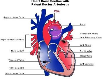 [350px-Patent_ductus_arteriosus[3].jpg]