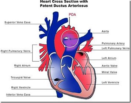 350px-Patent_ductus_arteriosus