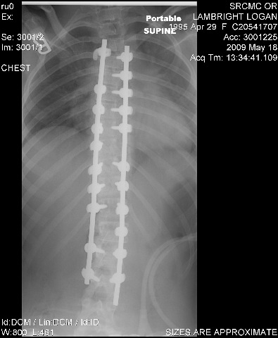 [Logans x-rays after surgery[2].jpg]