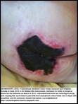 BRONKHORST Chris untreated bedsores buttocks hospice