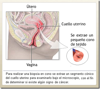 Extirpación de segmento cónico