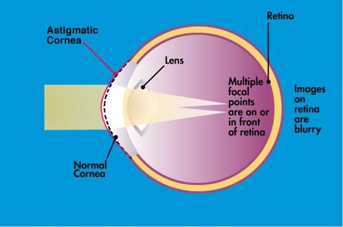 LASIK Guider - Laser Vision Correction Guide: Astigmatism