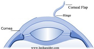 What Is Lasik