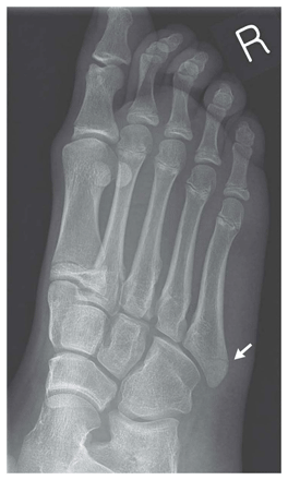 [metatarsal fracture[6].gif]