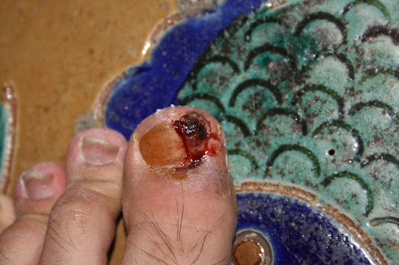 My Toe