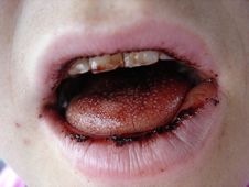 [blood-mouth[5].jpg]