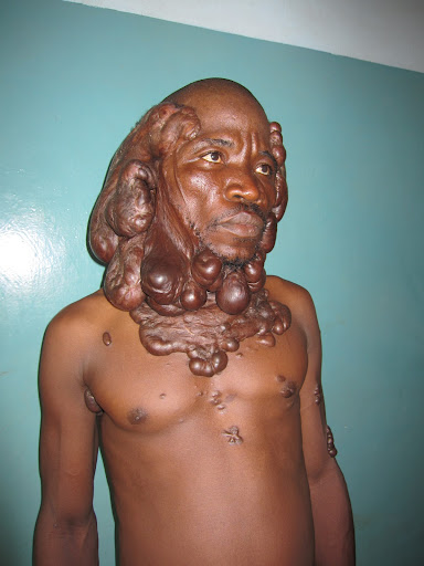keloids