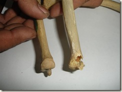 left (green markings) ulna has fusion on lower end(above 25 years), right has incomplete fusion at lower end (21-22 yrs)
