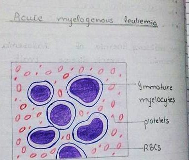 [acute myelgenous leukemia diagram H&E[2].jpg]