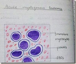 acute myelgenous leukemia diagram H&E