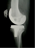 [knee_xray[3].jpg]