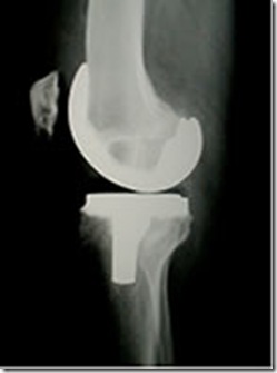 knee_xray