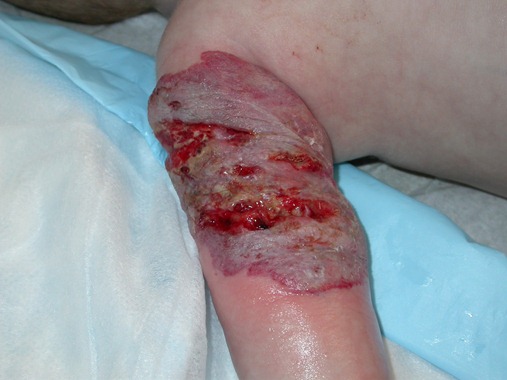 [bellahemangioma24.jpg]