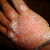 burnt hand