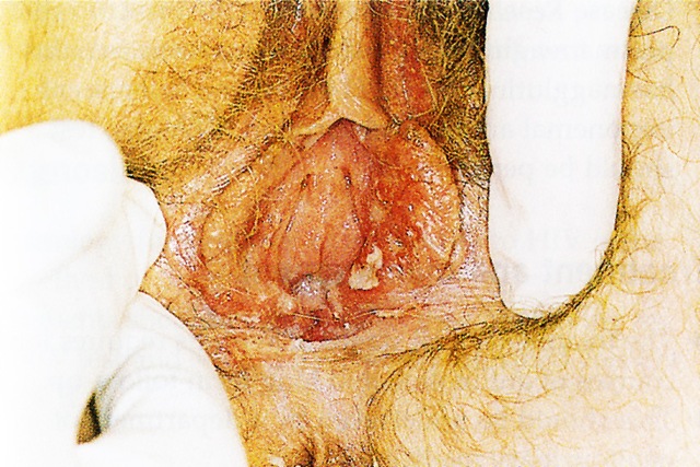 [Herpes GEnitalis[3].jpg]
