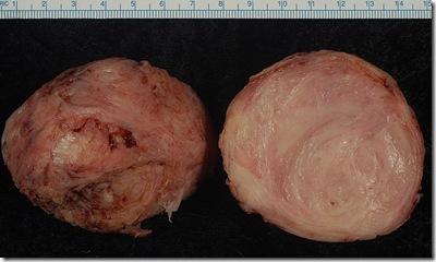 800px-Leiomyoma 800px-Leiomyoma