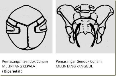 Pemasangan Sendok Cunam Pemasangan Sendok Cunam