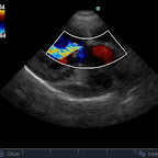 Aortic Regurgitation in Bacterial Endocarditis of the Aortic Valve