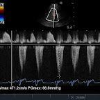 CW Doppler trace of Pulmonic Outflow also showing Pulmonic Regurgitation, Same Dog