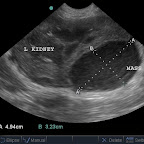 Renal Abscess in a 7yo Unstable Diabetic Weimeraner, Klebsiella cultured after ultrasound-guided drainage