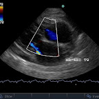 Mitral and Tricuspid Regurgitation, Same Cat
