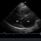 Diastolic frame of Mitral Stenosis in an English Bull Terrier (failure to open)