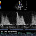 Continuous Wave Doppler trace of Mitral Stenotic jet, same dog