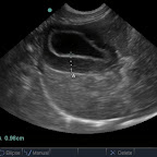 Gallbladder Wall Oedema in a hypoalbuminaemic puppy