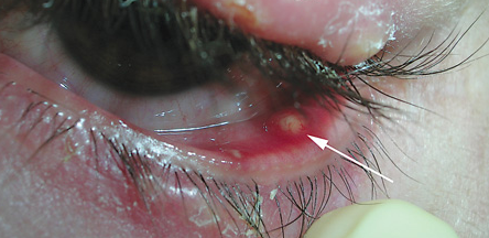 [chalazion[2].png]