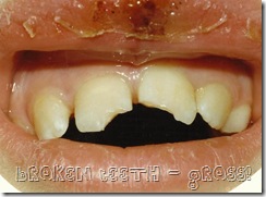 teeth1