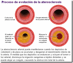 ateroescle