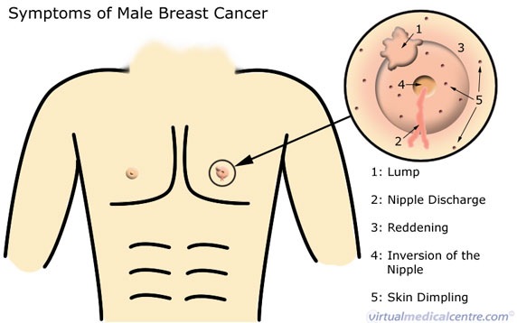 [male breast cancer[4].jpg]