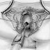 Askep / Asuhan Keperawatan Malformasi Anorektal thumbnail