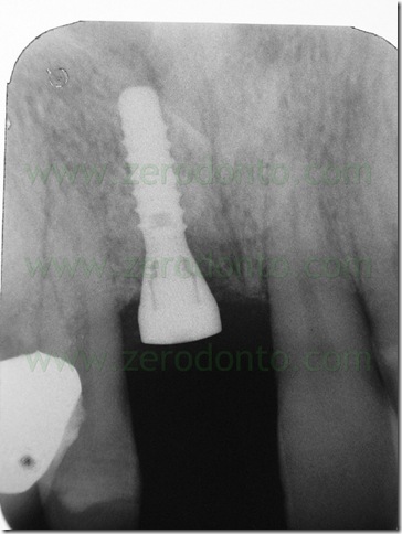 impianto straumann radiografia