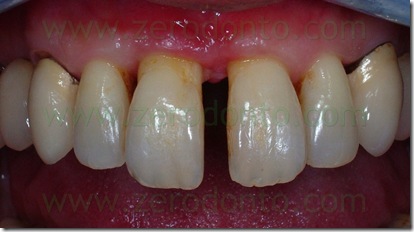diastema mediano