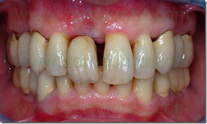 diastema mascellare