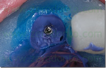 impronta permadyne