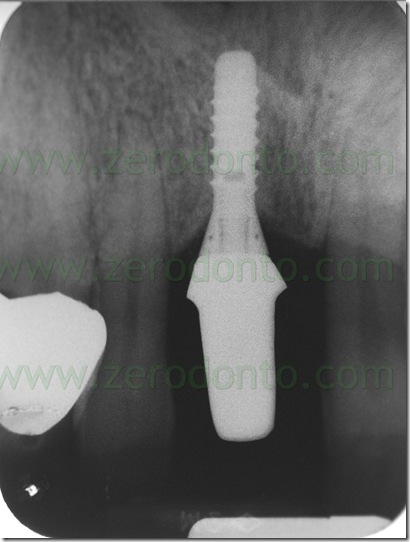 straumann impianto standard