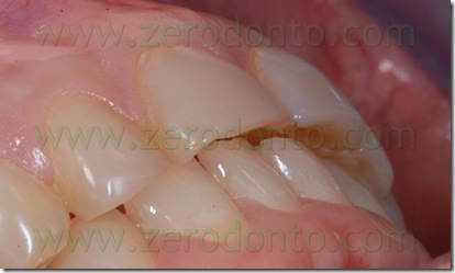 overjet overbite