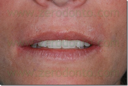 margine incisale
