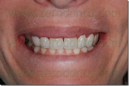 terzo incisale