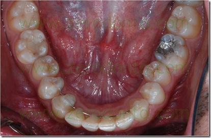 allineamento dentario senza sofferenza